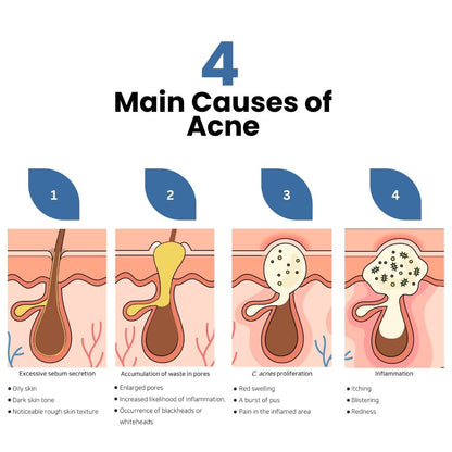 Acne D’fence 10yr+ SUNSCREEN SPF 50 PA++++ 50ml