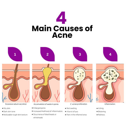 Acne D’fence 10yr+ Moisturiser - 50ml